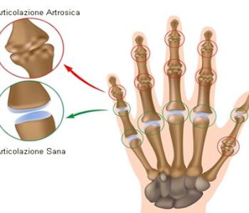 La Salute su Aostaoggi.it: le malattie dell’apparato osteoarticolare