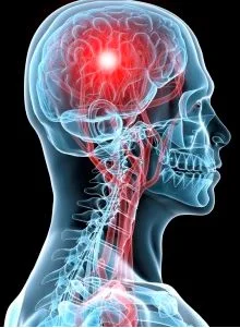 Ictus, tre iniziative di prevenzione organizzate da Alice onlus