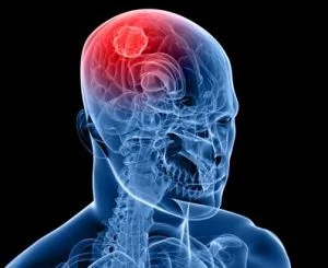 Ictus, l'ospedale Parini punto di riferimento nazionale per trattamento e cura