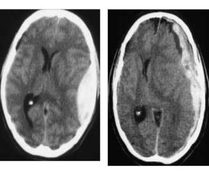 La salute su Aostaoggi.it: oggi si parla di trauma cranico