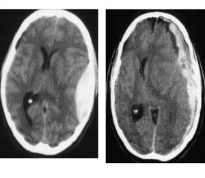 La salute su Aostaoggi.it: oggi si parla di trauma cranico