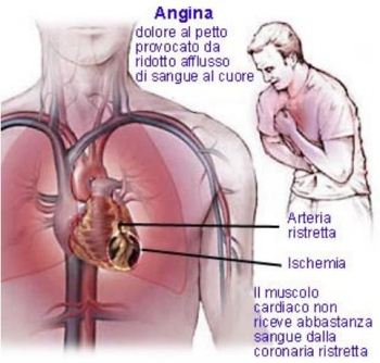 L'angina pectoris: come riconoscerla, curarla e prevenirla