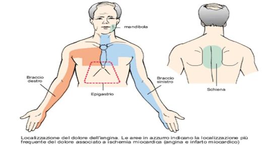 angina1