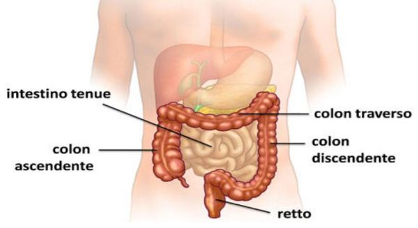 diverticolite