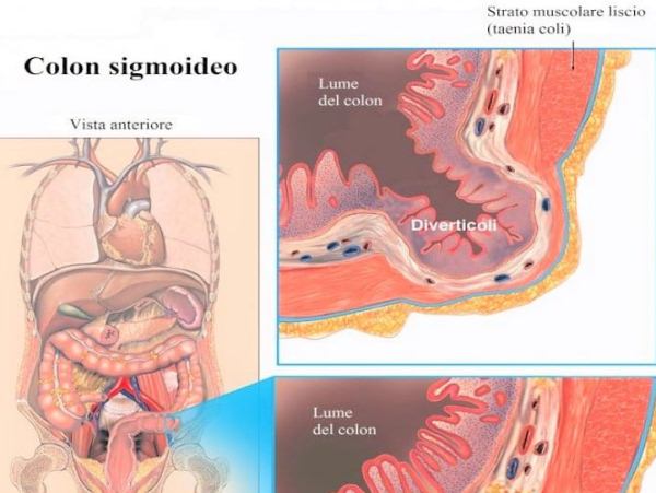 diverticolite