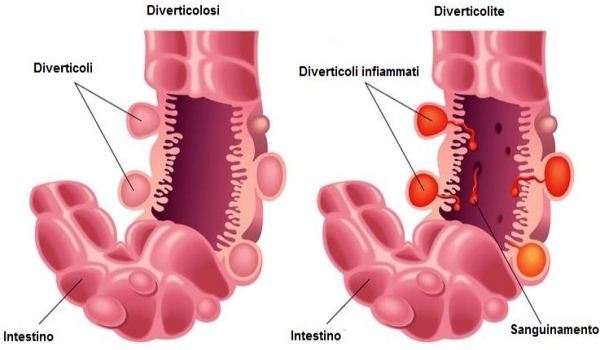 diverticolite