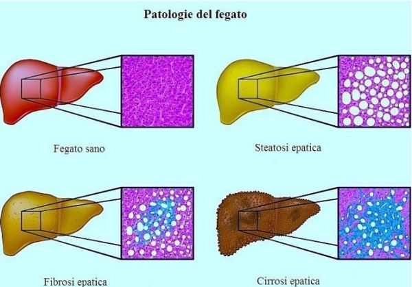 Epatite B e C: prevenzione e terapie innovative