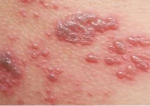 Herpes zoster