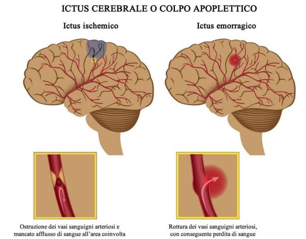 ictus