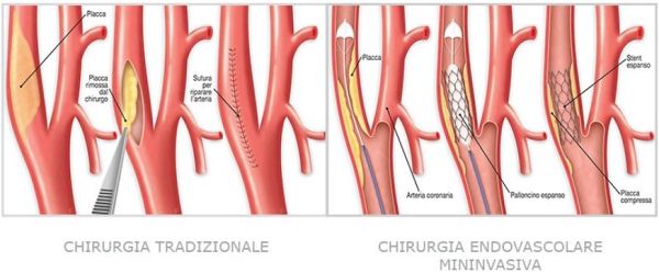 ictusa2