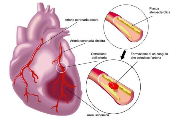 L'infarto del muscolo cardiaco: sintomi, diagnosi, prevenzione e ...