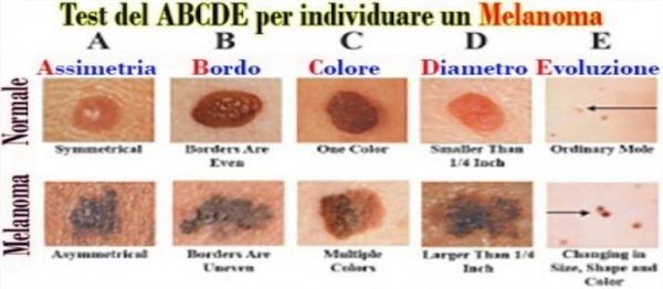 Test ABCDE per il Melanoma