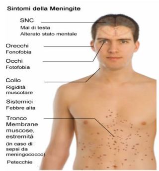 meningite batterica