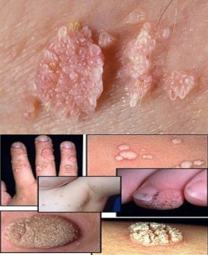 Papilloma al naso Hpv naso sintomi