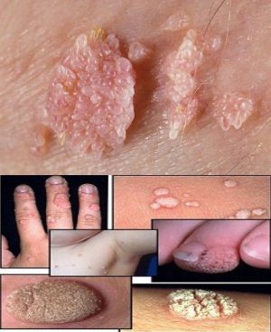 papilloma condilomi hpv