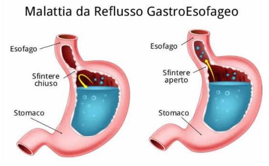 reflusso gastro-esofageo