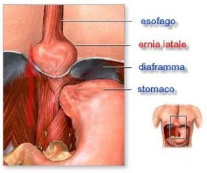 Reflusso gastro-esofaceo