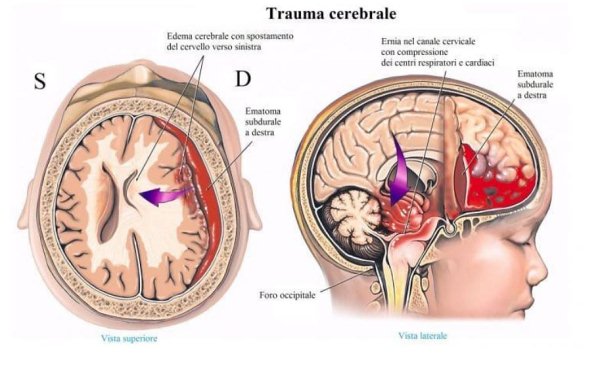 La Salute Su Aostaoggi It Il Trauma Cranico Lieve Nei Bambini Aostaoggi It