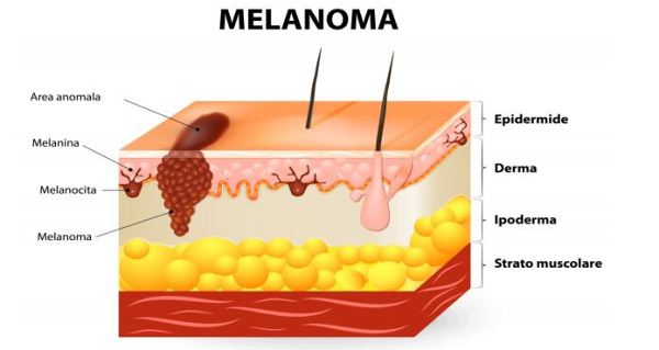 melanoma melanoma
