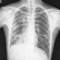 La tubercolosi (TBC): contagio, diagnosi, prevenzione e cura