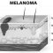 Il melanoma, il tumore più pericoloso e aggressivo della pelle