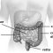 Diverticolosi e diverticolite, malattia del benessere: diagnosi e trattamento